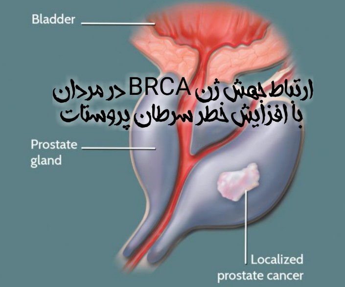 ارتباط جهش ژن BRCA در مردان با افزایش خطر سرطان پروستات  