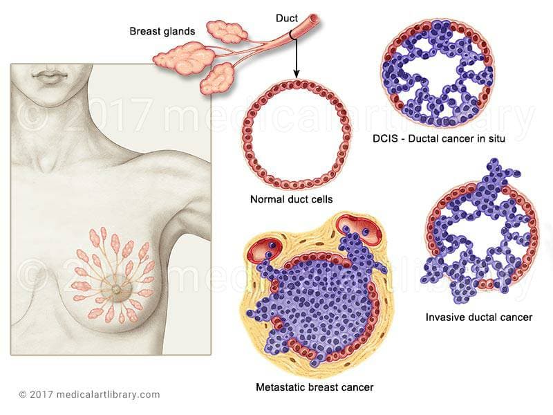 سطح  اینترلوکین6 (IL-6) عود سرطان پستان را زودتر پیش بینی می کند!