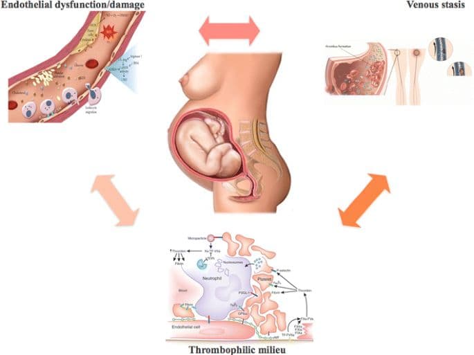 آمبولی ریوی در بارداری و پس از زایمان، تشخیص و درمان