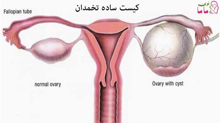 کیست ساده تخمدان در بارداری
