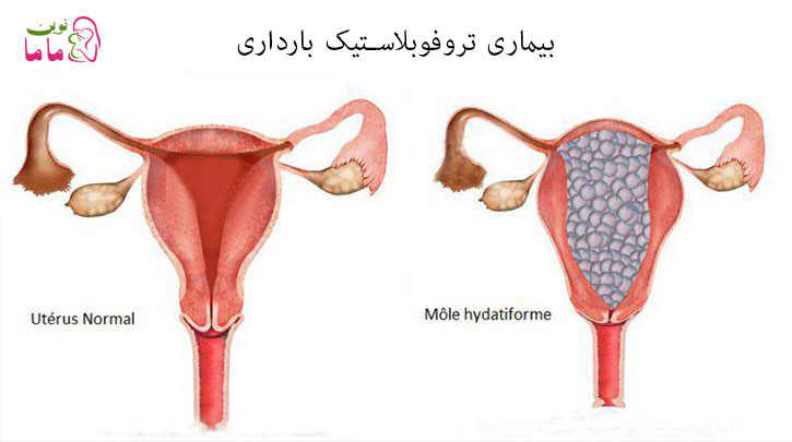 بیماری تروفوبلاستیک بارداری GTD