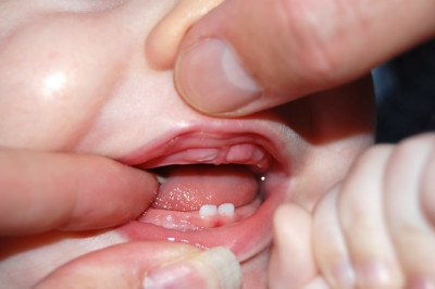 ضخامت خطوط نئوناتال در دندانهای شیری