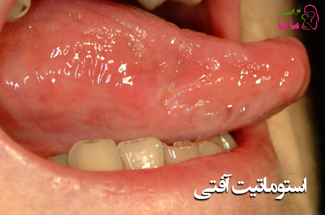 زخم دهانی عودشونده یااستوماتیت آفتی راجعه (RAS) 