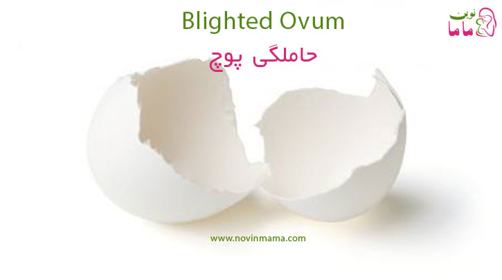 حاملگی پوچ Blighted Ovum