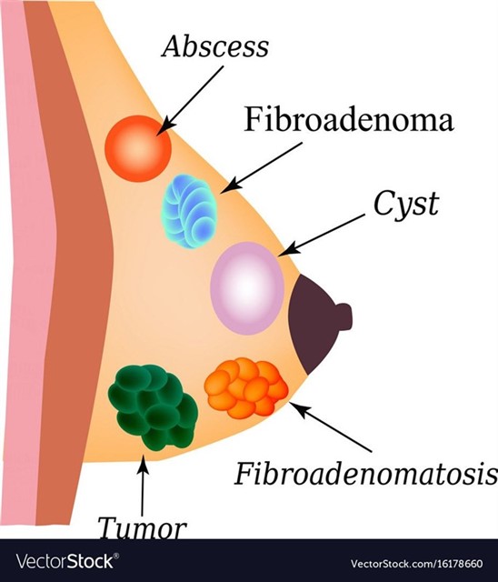  فیبروآدنوما از شایع ترین توده های غیر سرطانی (خوش خیم) پستان در زنان جوان است.
