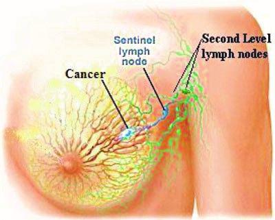غدد لنفاوی سرطان زیر بغل پستان