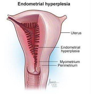 هیپرپلازی آندومتر اغلب به دلیل استروژن بیش از حد بدون پروژسترون ایجاد می شود.