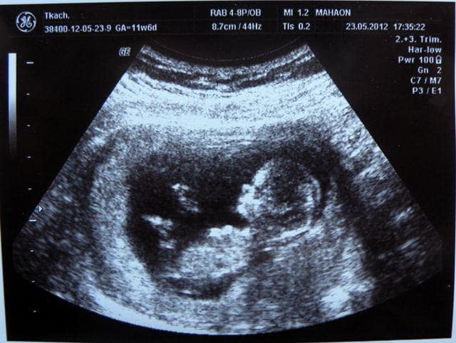 سونوگرافی سه ماهه دوم بارداری : از هفته 15 تا 28 بارداری است .