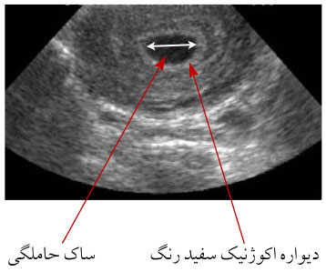 اولین سونوگرافی در دوران بارداری با هدف تشخیص ساک حاملگی و بررسی احتمال حاملگی خارج از رحم یاحاملگی مولار انجام می‌شود.