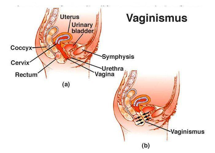 واژینیسموس Vaginismus عبارت است از انقباض غیرارادی عضلات یک سوم خارجی مهبل که مانع دخول آلت تناسلی مرد و نزدیکی می شود.