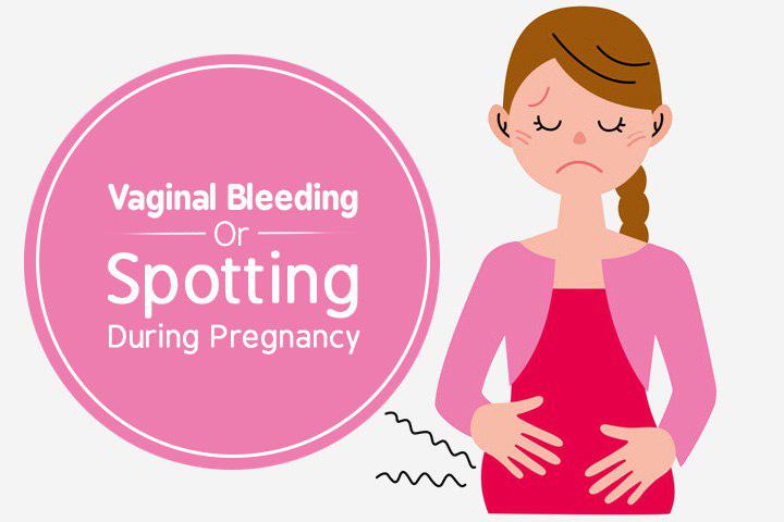 خونریزی غیرطبیعی  در اواخر بارداری ممکن است جدی تر باشد، زیرا می تواند مشکل مادر یا نوزاد را نشان دهد