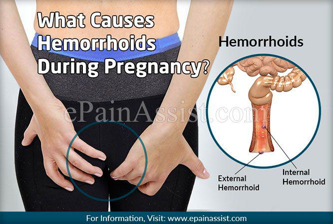 بارداری و زایمان واژن به دلیل تغییرات هورمونی و افزایش فشار داخل شکمی، باعث ایجاد بواسیر (هموروئید) می شود. 