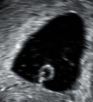سونوگرافی سقط