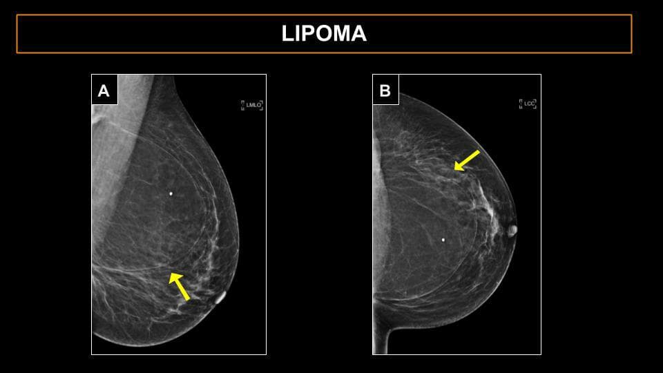  لیپوماهای پستان تومورهای خوش خیمی هستند که معمولاً از سلولهای چربی بالغ تشکیل شده اند. 