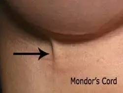 بیماری mondor پستان