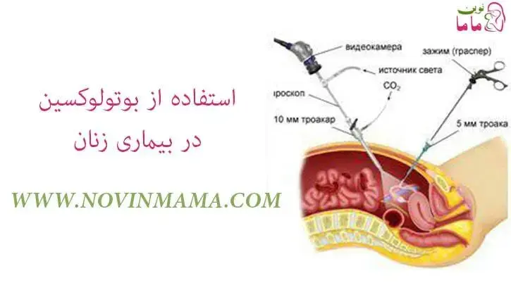 استفاده از بوتولوکسین در بیماری زنان