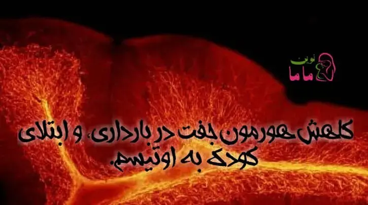 ارتباط کاهش هورمون جفت دربارداری وابتلای کودک به اوتیسم
