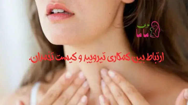 ارتباط بین کم کاری تیروئید و کیست تخمدان