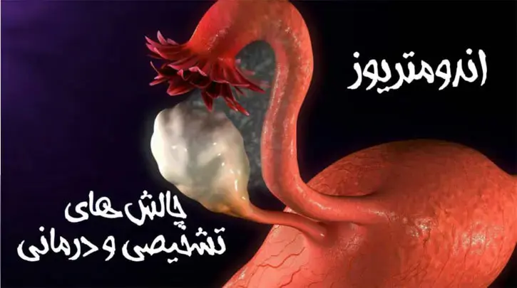 آندومتریوز: چالش های تشخیصی و درمانی
