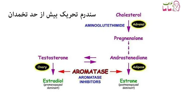 سندرم تحریک بیش از حد تخمدان 