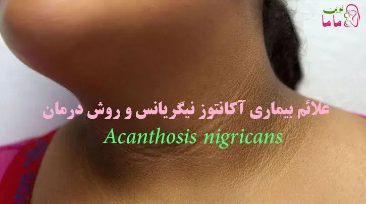علائم بیماری آکانتوز نیگریانس و روش درمان آن