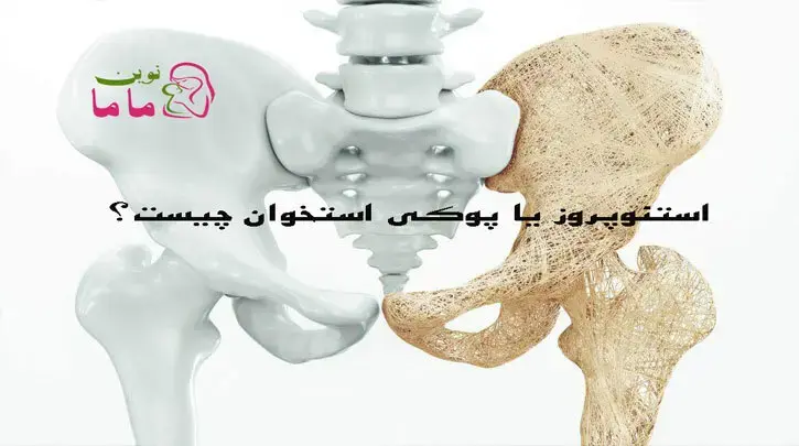 استئوپروز یا پوکی استخوان چیست؟