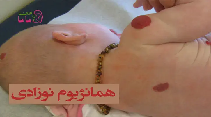 همانژیوم نوزادی