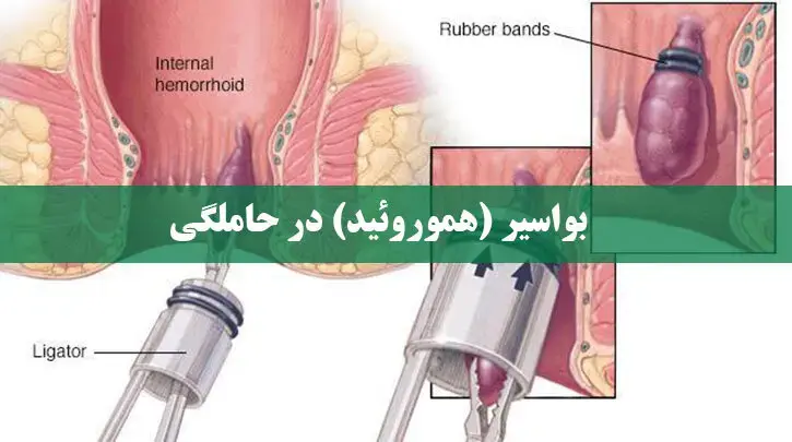 بواسیر (هموروئید) در حاملگی