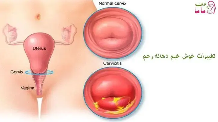 تغییرات خوش خیم دهانه رحم
