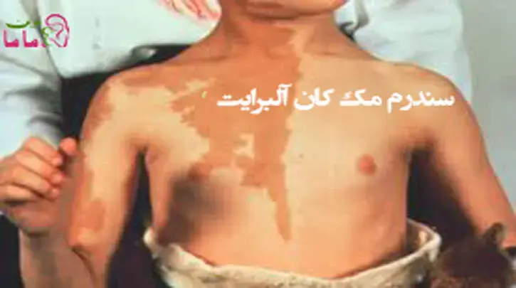 سندرم مک کان آلبرایت