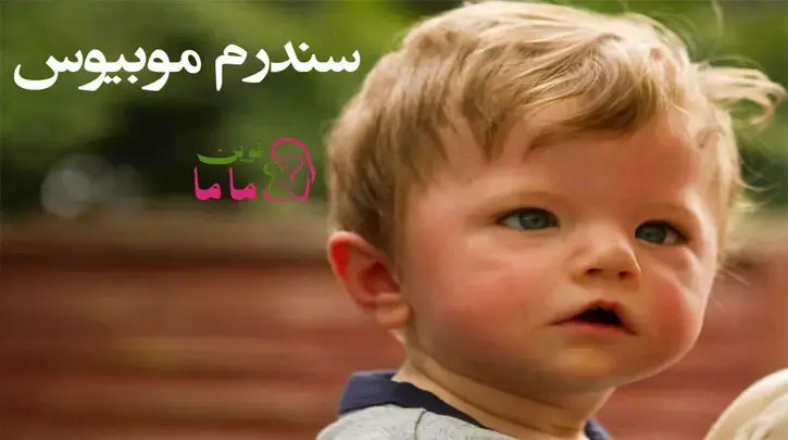 سندرم موبیوس