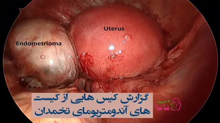 گزارش کیس هایی از کیست های آندومتریومای تخمدان
