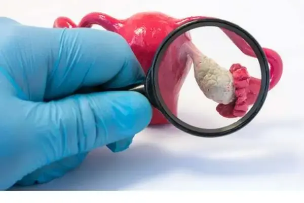 اختلالات متابولیسم گلوکز و فنوتیپ و شدت PCOS