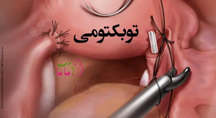 توبکتومی