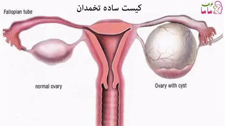 کیست ساده تخمدان