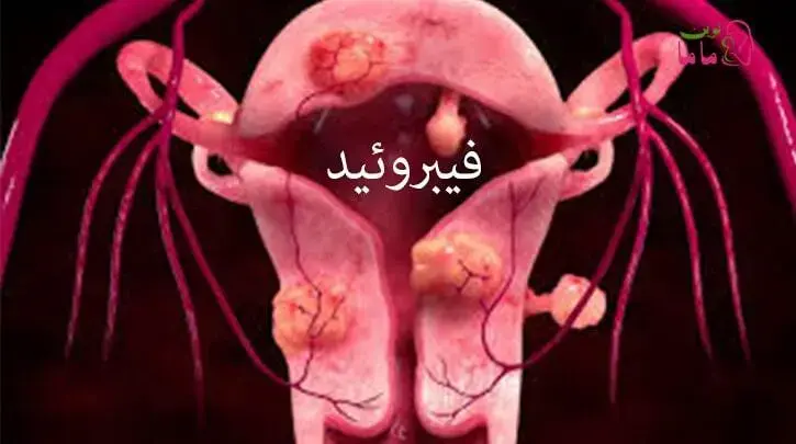 فیبروئید