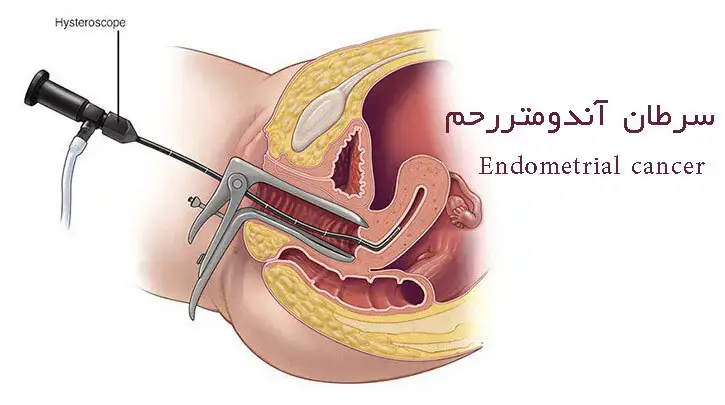 سرطان آندومتر رحم Endometrial cancer