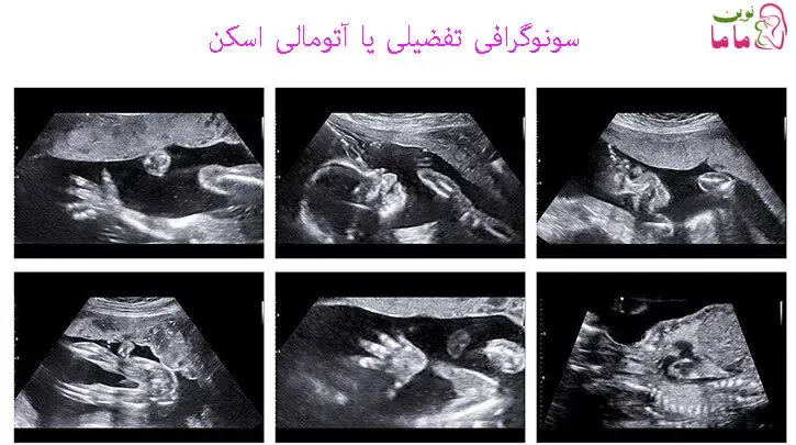 سونوگرافی تفضیلی یا آتومالی اسکن