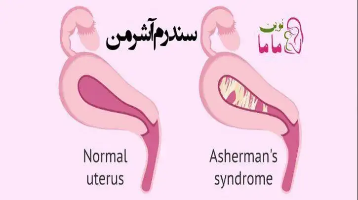 سندروم آشرمن