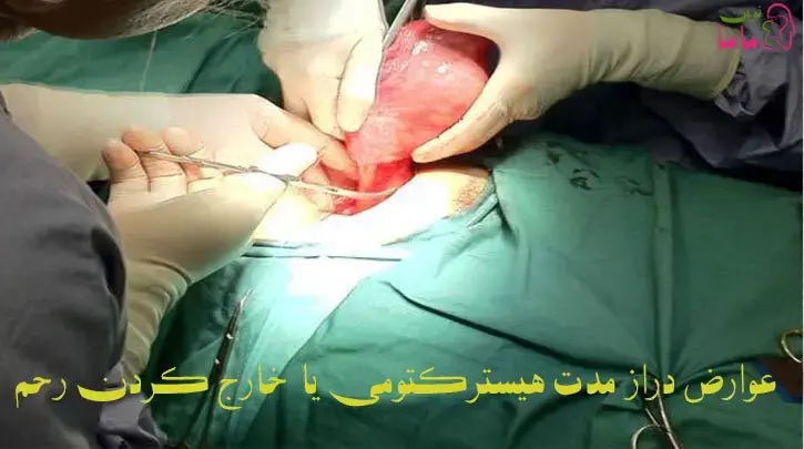 عوارض دراز مدت هیسترکتومی یا خارج کردن رحم