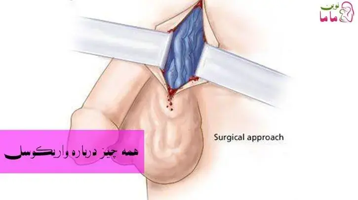 واریکوسل