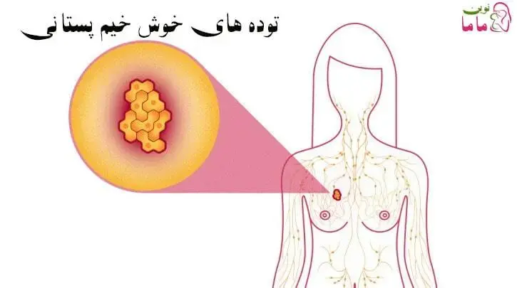 توده های خوش خیم پستانی