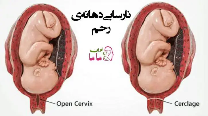 نارسایی دهانه رحم