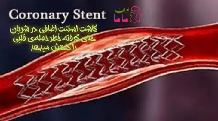 کاشت استنت اضافی در شریان‌های گرفته خطر حمله قلبی را کاهش می‌دهد!