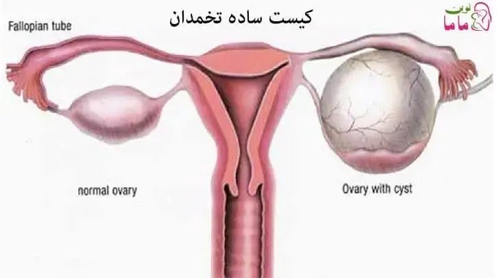 کیست ساده تخمدان در بارداری
