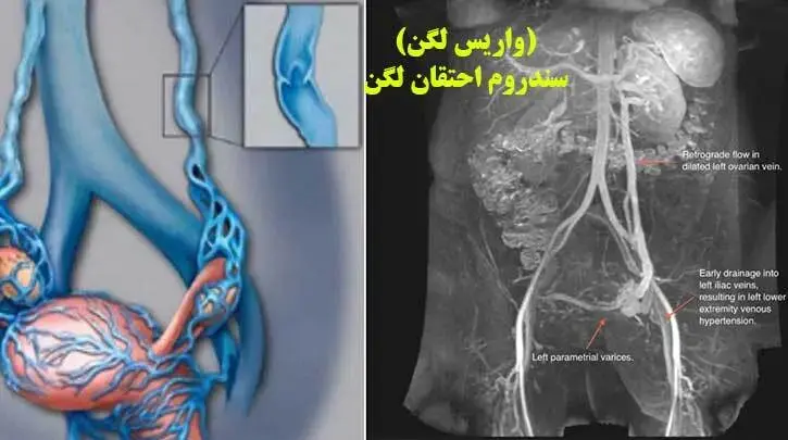 سندروم احتقان لگن (واریس لگن)