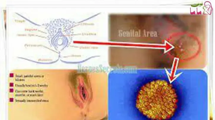 نحوه برخورد با هرپس ژنیتال در حاملگی