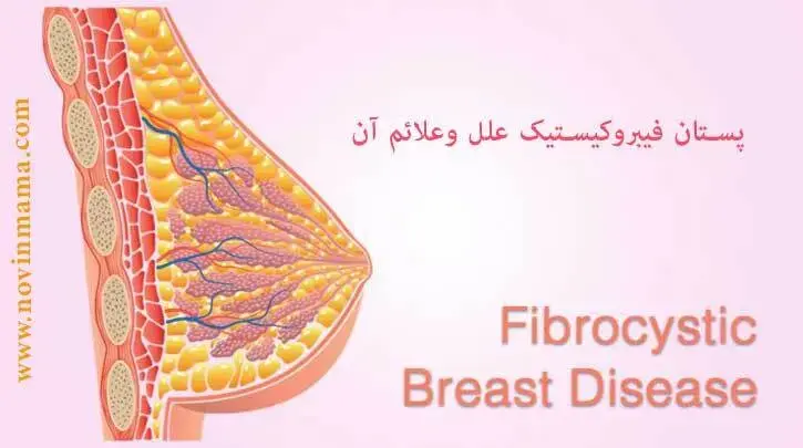 پستان فیبروکیستیک علل وعلائم آن