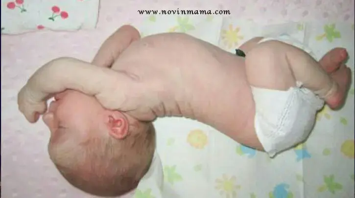 ریفلاکس معده به مری 