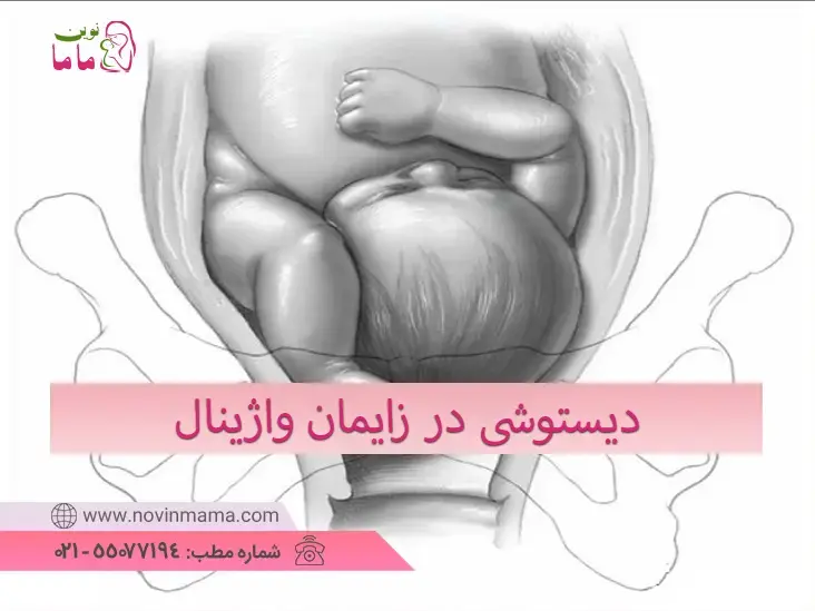 دیستوشی در زایمان واژینال